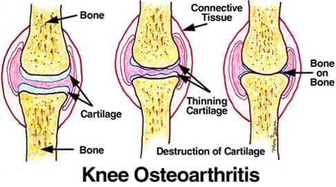 Osteoarthritis - See Achievement 3