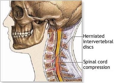 Cervical and Lumbar spondylosis - See Achievement 5