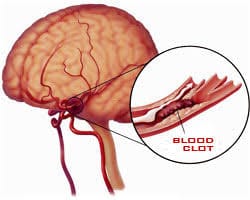 Cerebral Thrombosis