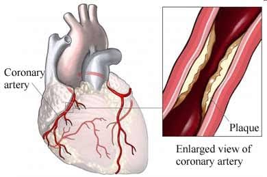 Coronary Artery