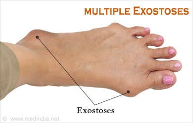 Exostoses