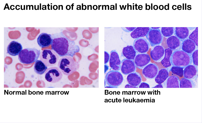 Leukemia - See Achievement 8