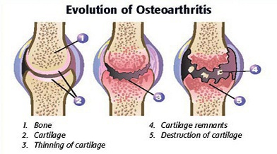 Osteoarthritis