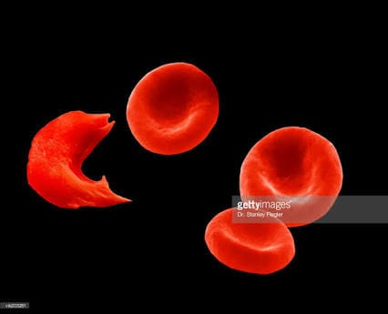 Sickle Cell Anemia - See research background of about us
