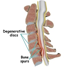 Spinal Canal Stenosis