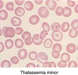 Thalassemia Minor - See research background at about us