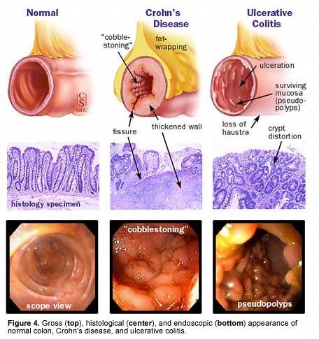 Ulcerative Colitis - Visit Sure Cure